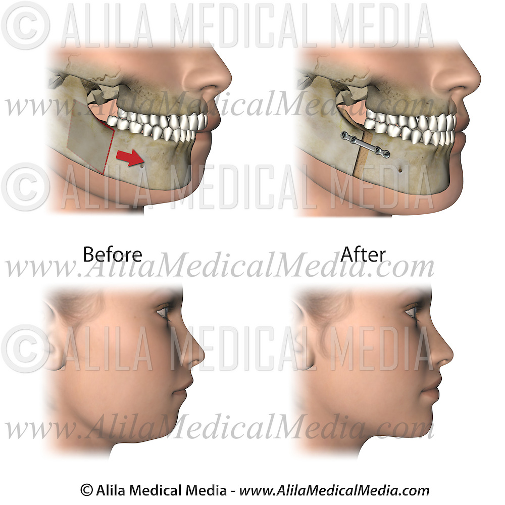 Corrective jaw surgery for micrognathia Alila Medical Images