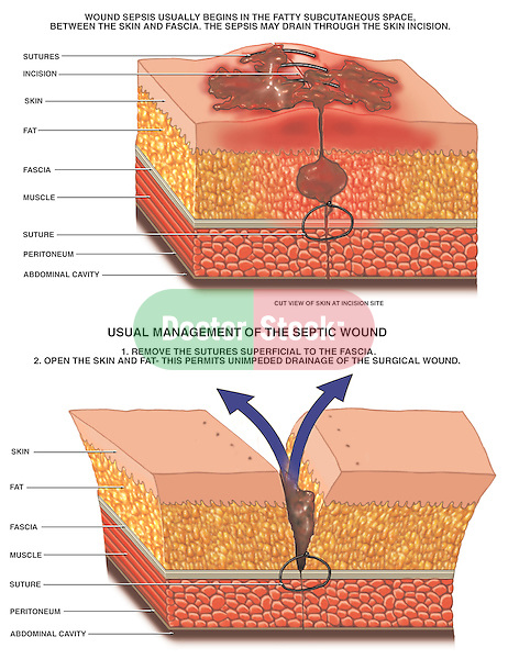 This medical exhibit depicts two (2) enlarged cut-away sections of the skin depicting septic surgical wound management for post-operative skin infections. The first illustration illustrates a septic wound beginning in the fatty subcutaneous space between the skin and fascia, draining through a skin incision. It includes labels for sutures, skin, fat, fat fascia, muscle, peritoneum and the abdominal cavity. The second illustration pictures the usual management of the septic wound including removing the sutures superficial to the fascia, then opening the skin and fat, permitting drainage of the infected wound.