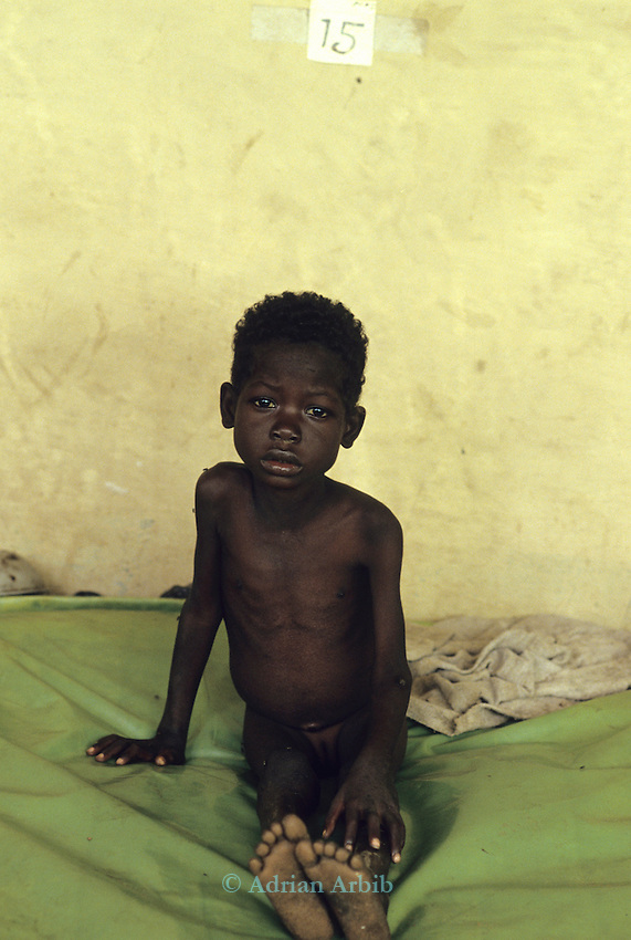 A Dinka girl in a makeshift hospital at Thiet feeding camp in Southern Sudan. Hundreds of Dinka tribes people having had their villages bombed and burnt by the Khartoum forces have travelled hundreds of miles to avoid hunger and death.