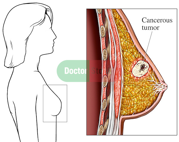 This full color medical illustration pictures a cancerous tumor within the female breast. The first graphic provides a line orientation to the female breast in a lateral (side) view. A separate enlarged image identifies and illustrates the tumor within the breast tissue. ..